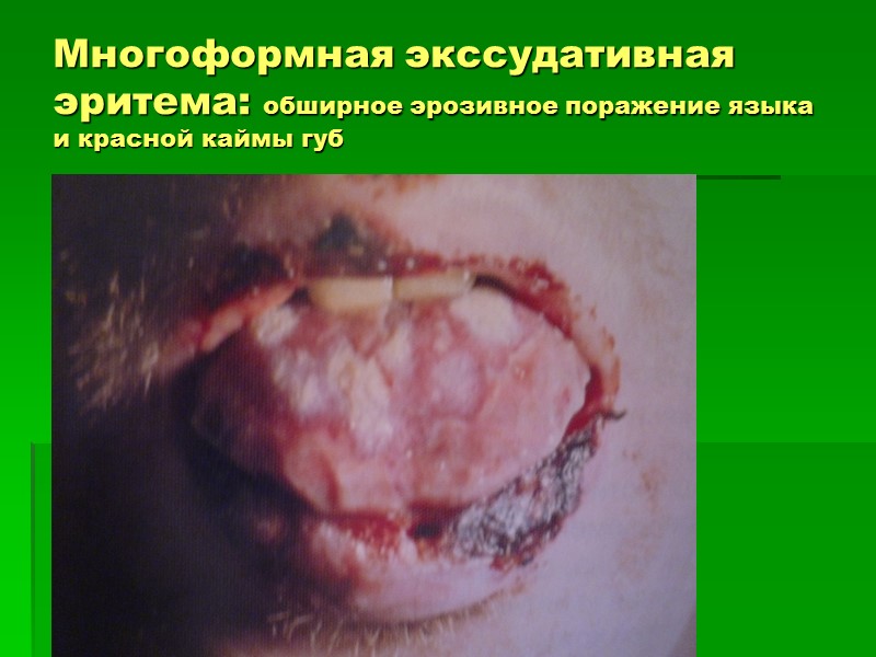 Многоформная экссудативная эритема: обширное эрозивное поражение языка и красной каймы губ